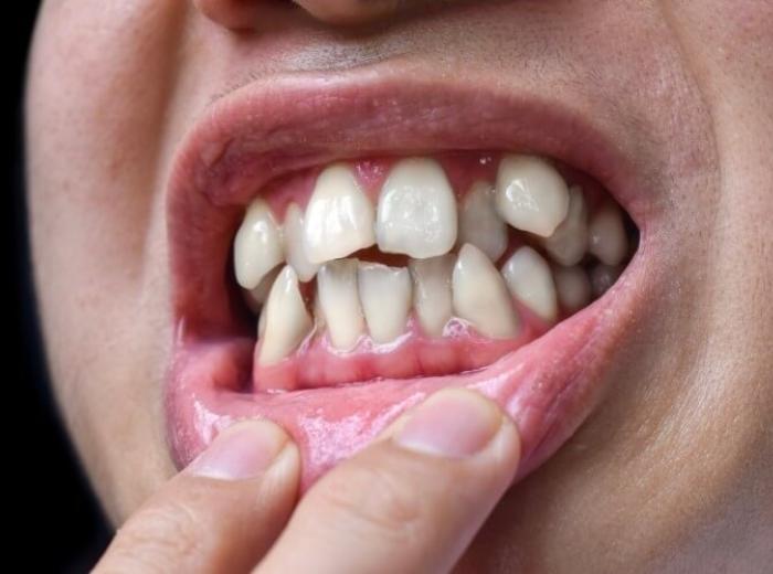 My Dentist For Life Has Earned The Distinction For Being A Platinum Invisalign Provider 2023