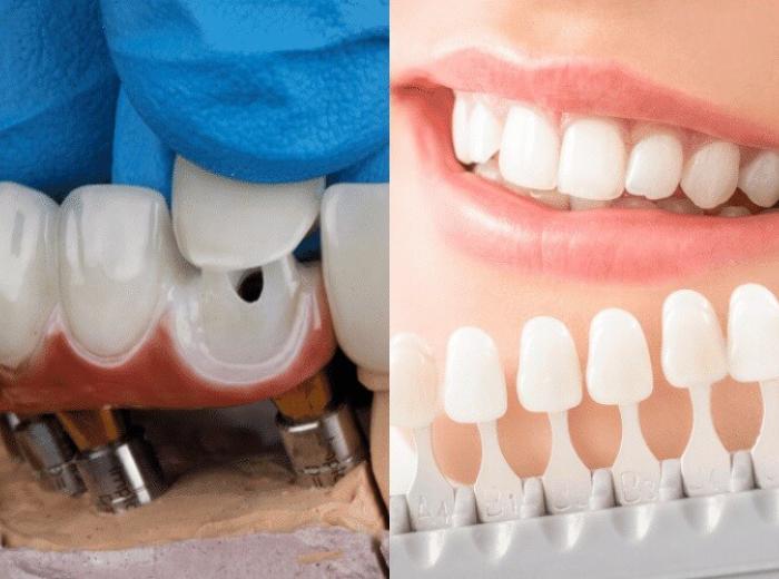 Which is Better: Crowns or Veneers for Front Teeth?