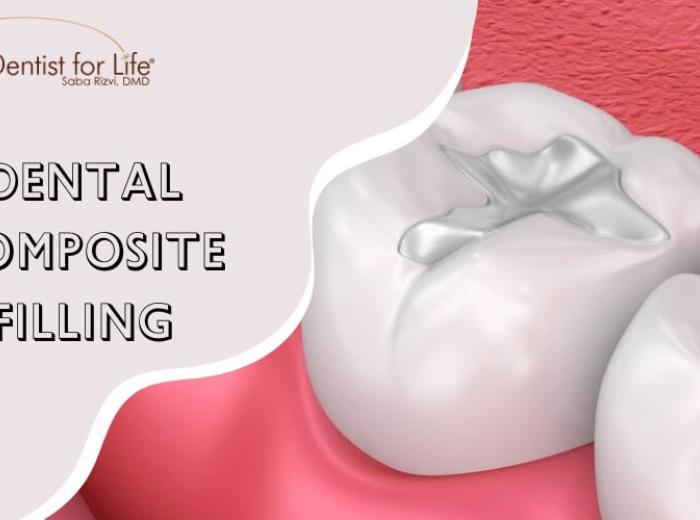 5 Common Mistakes To Avoid After A Dental Composite Filling