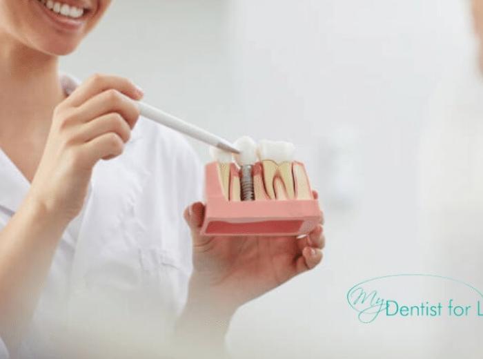 8 Common Questions On Dental Implants