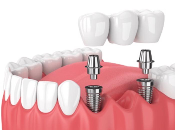 When Are Dental Bridges A Better Choice Than Dental Implants?
