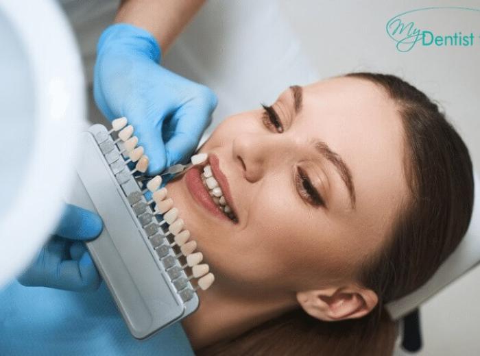 6 Things To Know Before Getting Dental Veneers