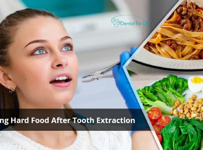 When Can I Eat Hard Food After Tooth Extraction