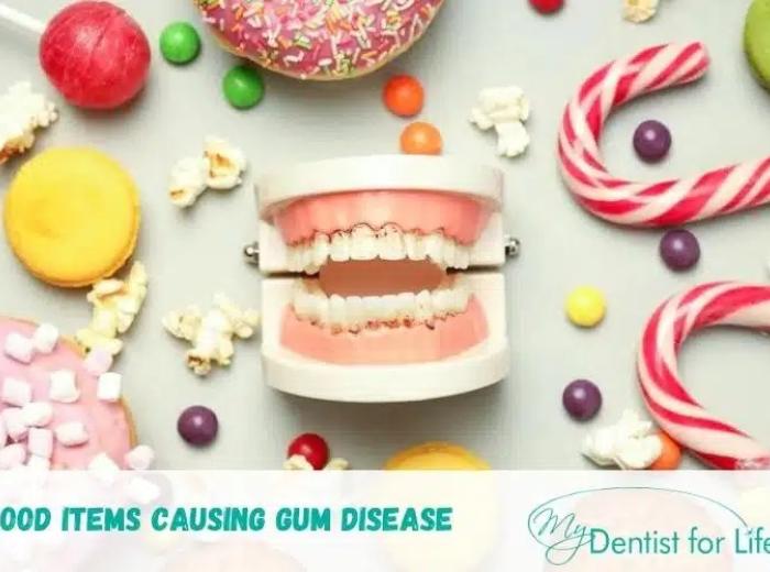 A Definitive Guide To The Food Items Causing Gum Disease