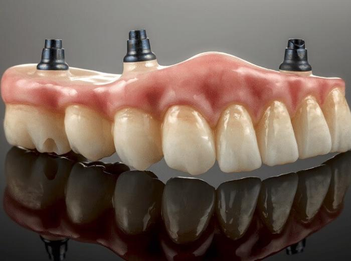 Can You Choose Dentures If You Have Receding Gums?