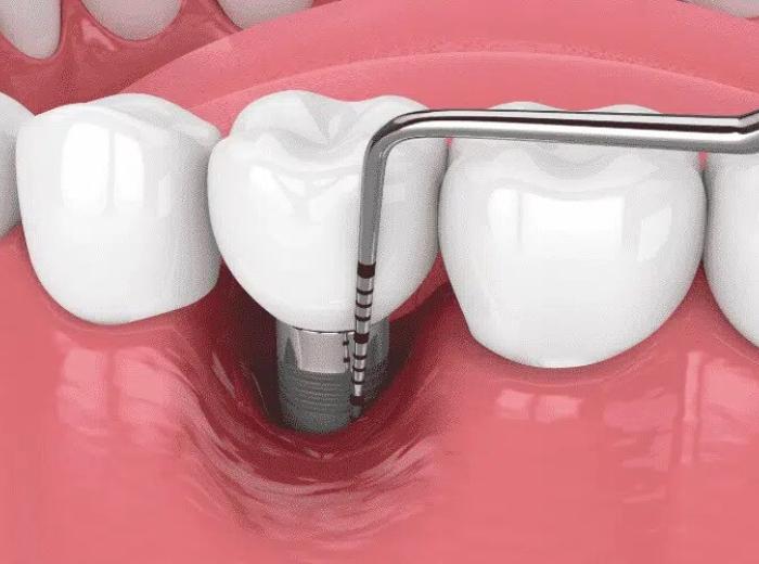 Consulting Your Dentist About Guided Biofilm Therapy: Key Questions to Ask