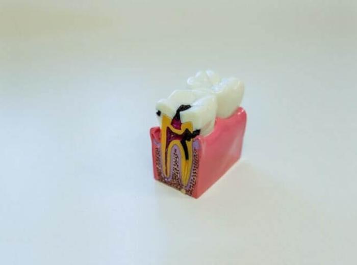 Periodontal Disease – Stages & Tips To Avoid It