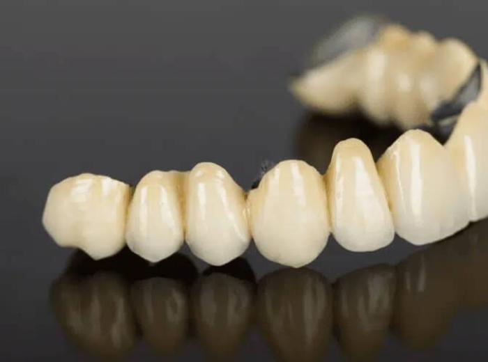 How Long Can You Expect Porcelain Bridges to Last?