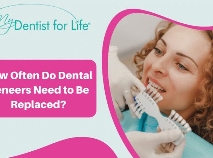 How Often Do Dental Veneers Need to Be Replaced?