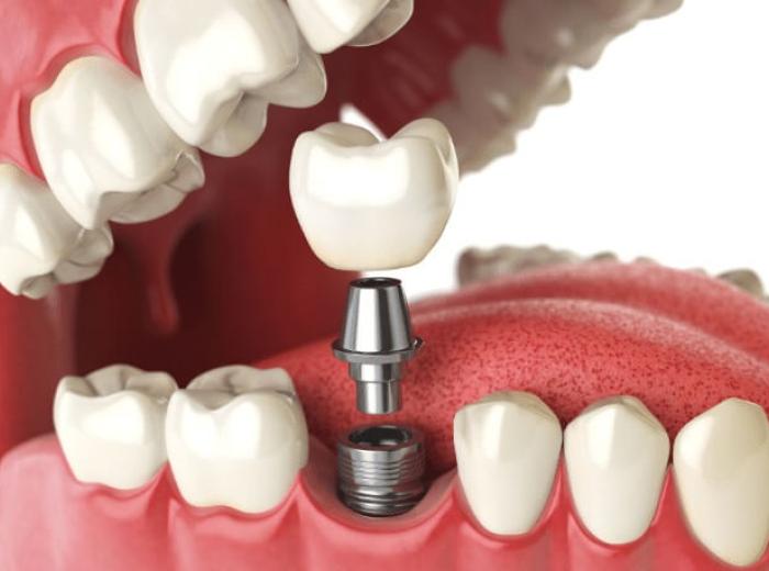 How to Care for Your Dental Implants to Ensure Longevity?