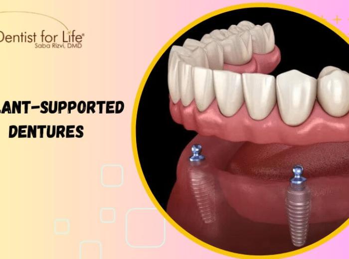 Understanding The Process Of Implant-Supported Dentures