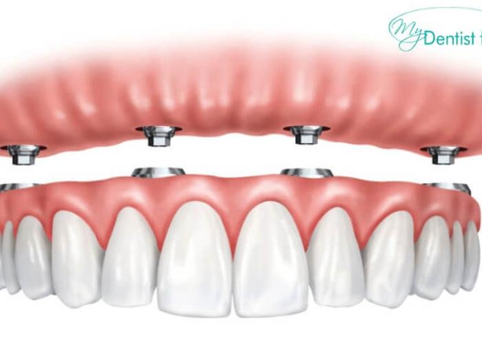 Implant Supported Dentures – Why You Should Go For It!