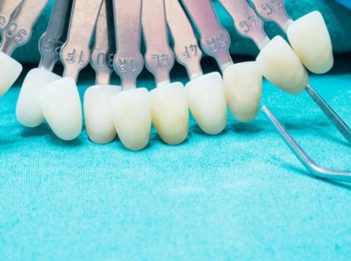 Get Dental Veneers To Restore The Beauty Of Your Smile