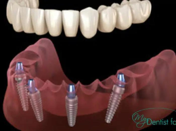 How Painful Is All-on-4 Implants?