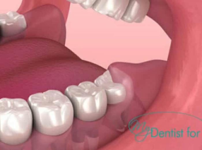 How long will your jaw hurt after tooth extraction?