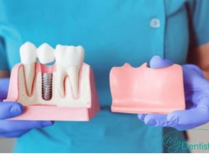 What are the Reasons for Dental Implant Failure?