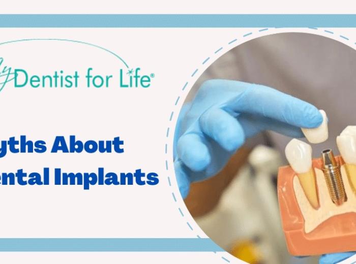 5 Myths About Dental Implants You Should Know