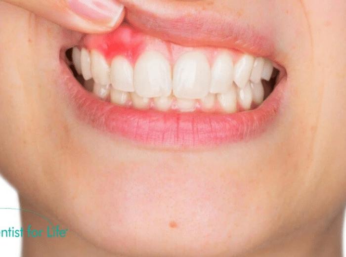 Know The Common Signs Of Periodontitis