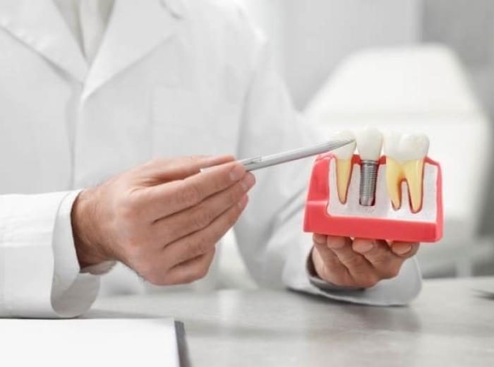 How to Speed Up Recovery After Getting All-on-4 Dental Implants?