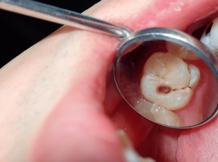 Is It Possible to Reverse Cavities Without a Dentist? Uncover the Truth