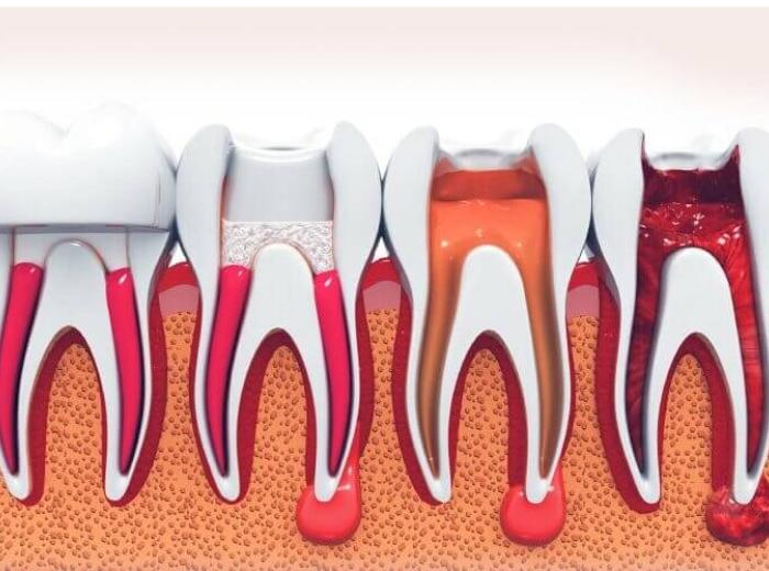 All You Need To Know About Root Canal Therapy