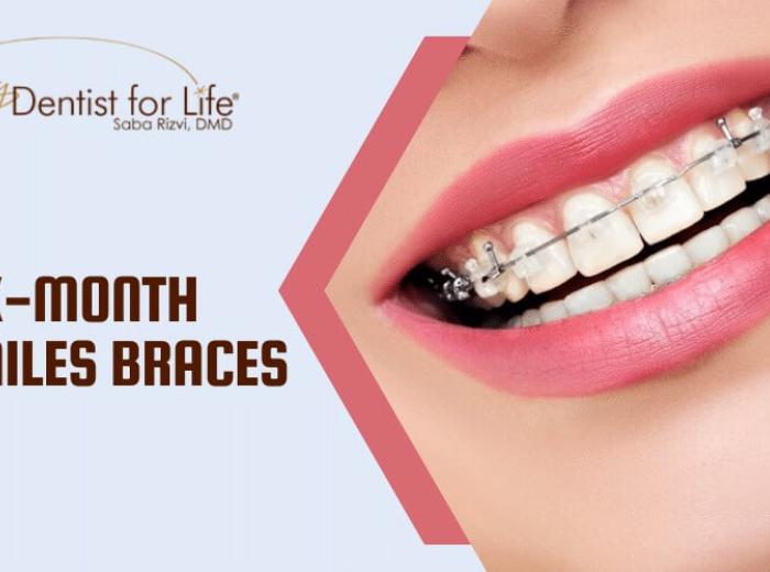 How Are Six-Month Smiles Braces More Comfortable Than Regular Braces?