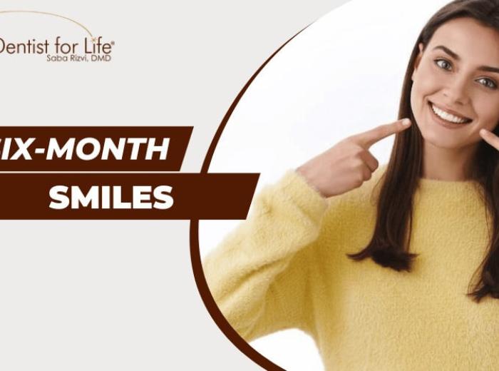 5 Reasons Six-Month Smiles is Best For You? 