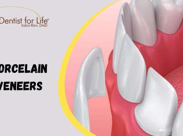 Signs It’s Finally Time For Porcelain Veneers