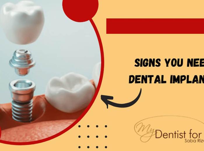 What Are the Top 5 Signs That You Need Dental Implants?
