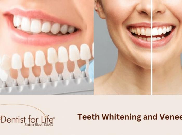 Teeth Whitening: Safely Enhance Your Smile