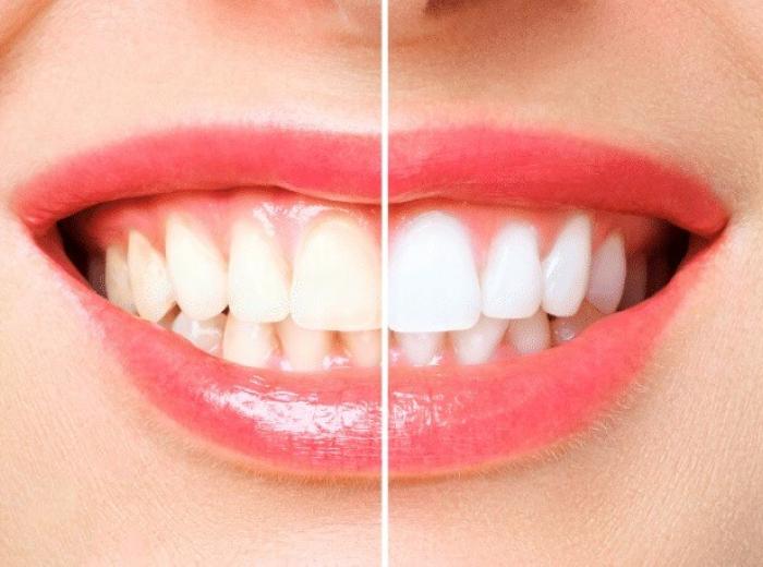 What Are the Best Teeth Whitening Options for Sensitive Teeth?