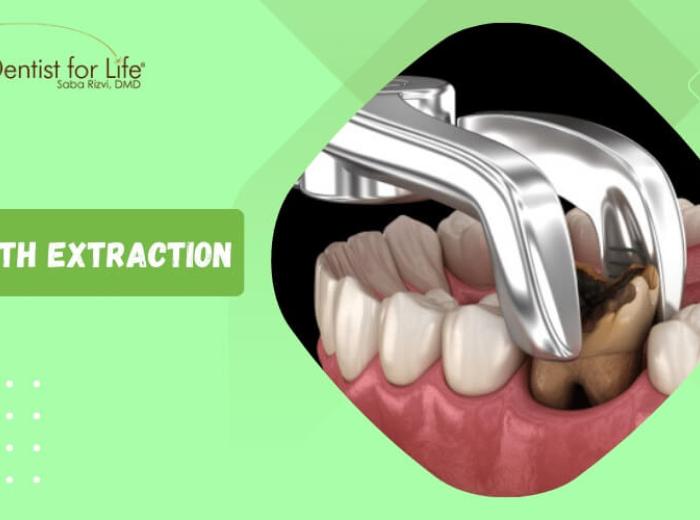 Tooth Extraction: When Is It Necessary