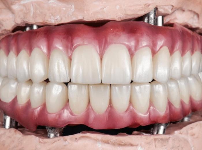 Why Are All-on-4 Dental Implants a Game-changer for Full Mouth Restoration?