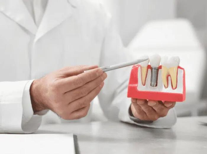 Why Is Gum Health Crucial for Dental Implants? Insights and Tips