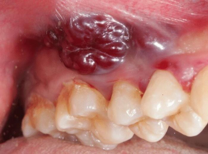 Can Coffee Make My Teeth Blackish?