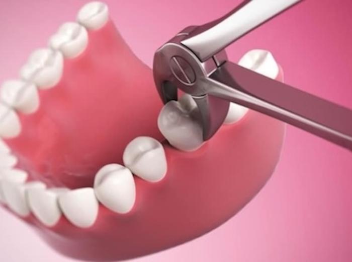 What to Eat After Tooth Extraction