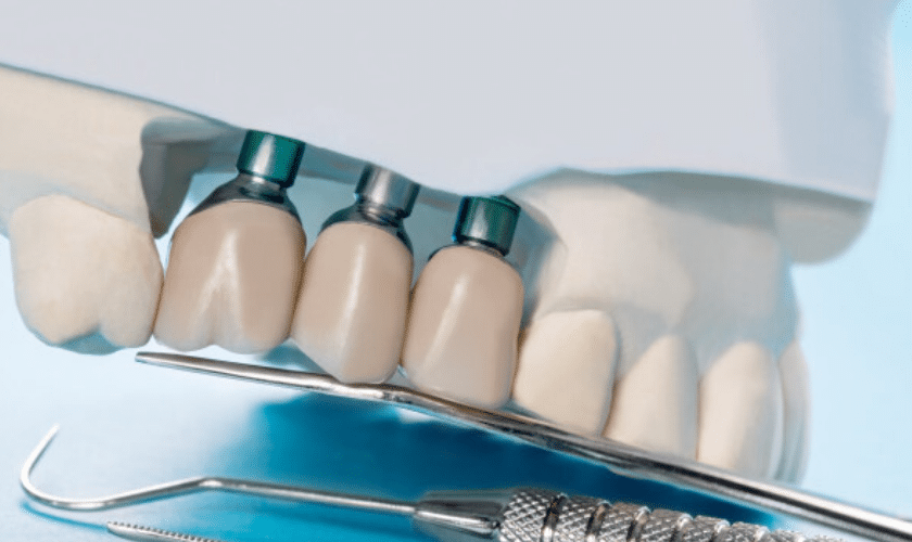 implant supported dentures