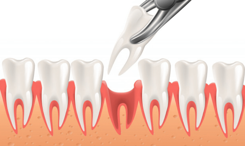 An Overview On Tooth Extraction Procedure