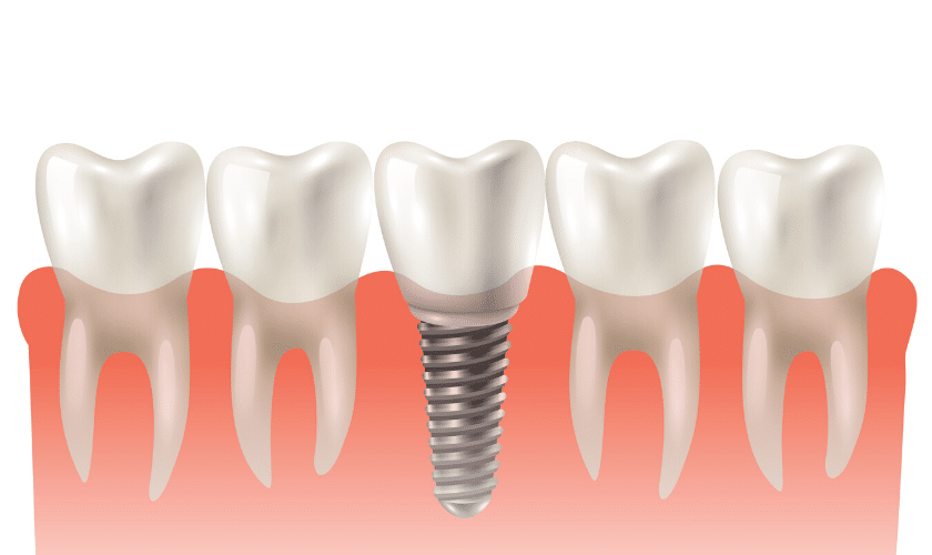 dental implants Plantation