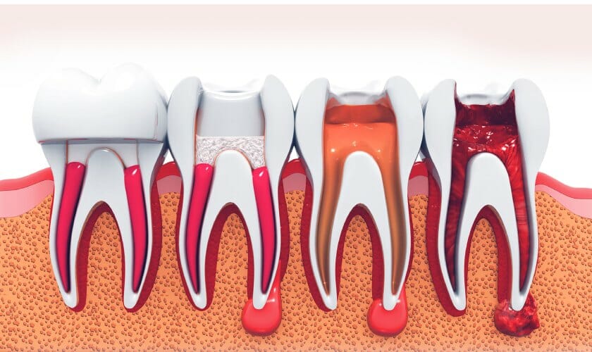 Root Canal Therapy in Plantation FL