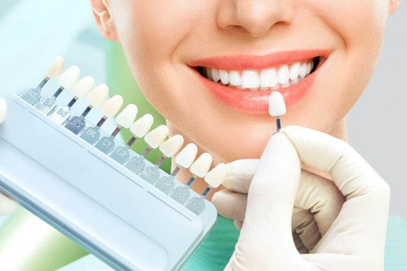 Porcelain Veneers