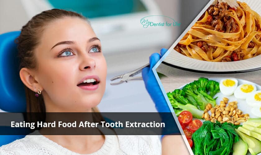 eating food after tooth extraction