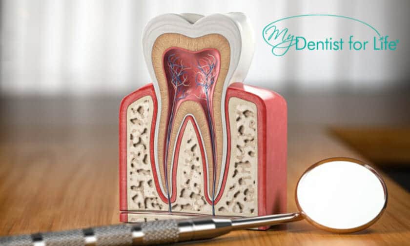 How does a cavity turn into a root canal?