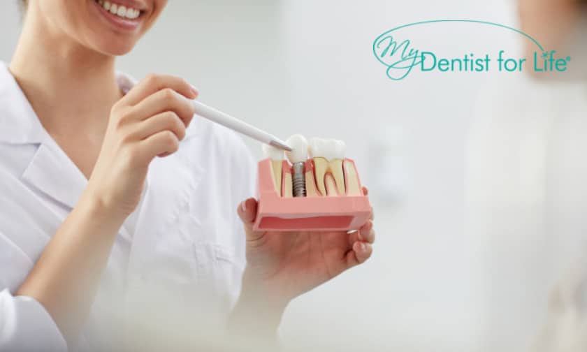 Dental Implants