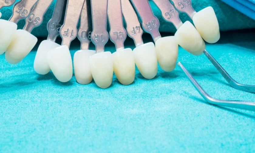 Benefits Of Dental Veneers