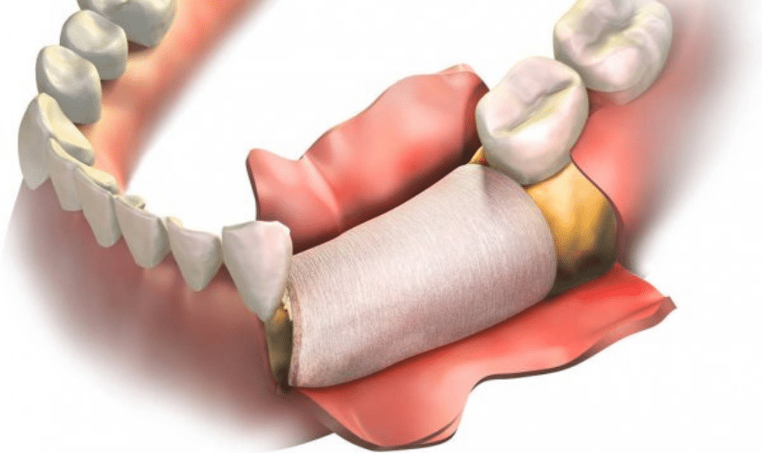 Bone Grafting