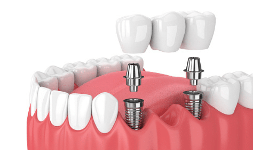 dental implants vs bridges