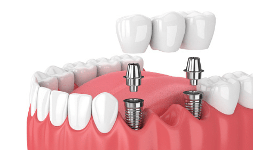 Dental Implant