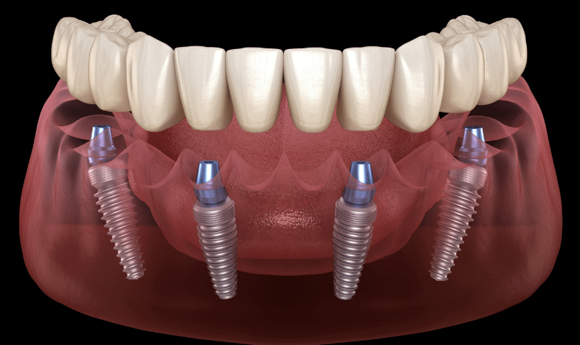 All-On-4-Implants