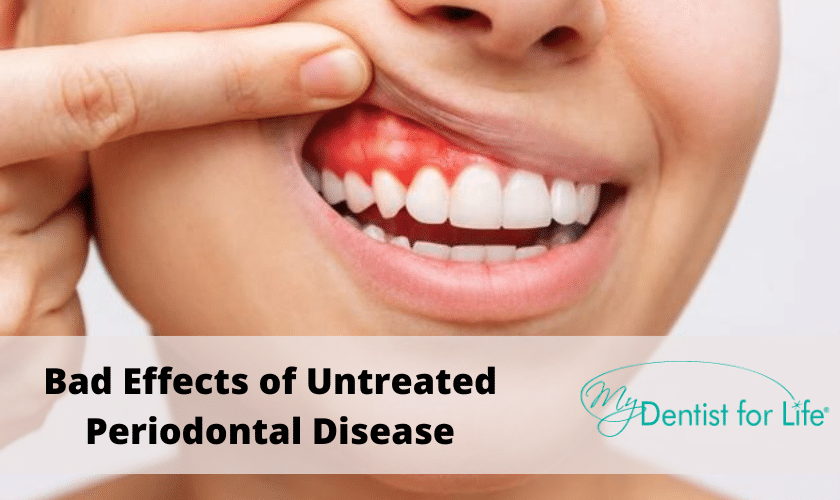 Bad Effects of Untreated Periodontal Disease